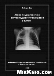 Атлас по диагностике внутригрудного туберкулеза у детей