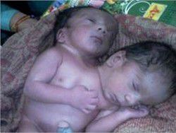 В Индии врачи борются за жизнь сиамских близнецов